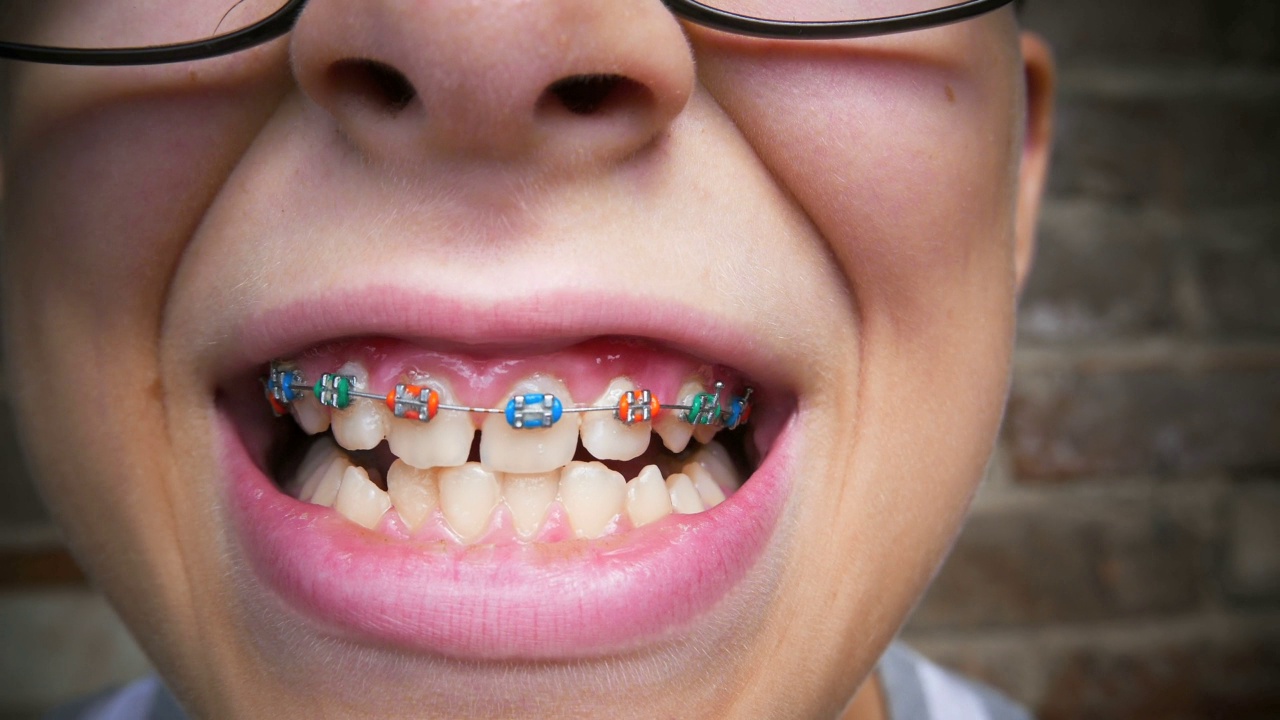 小男孩牙齿位置异常，用金属牙套矫正视频素材