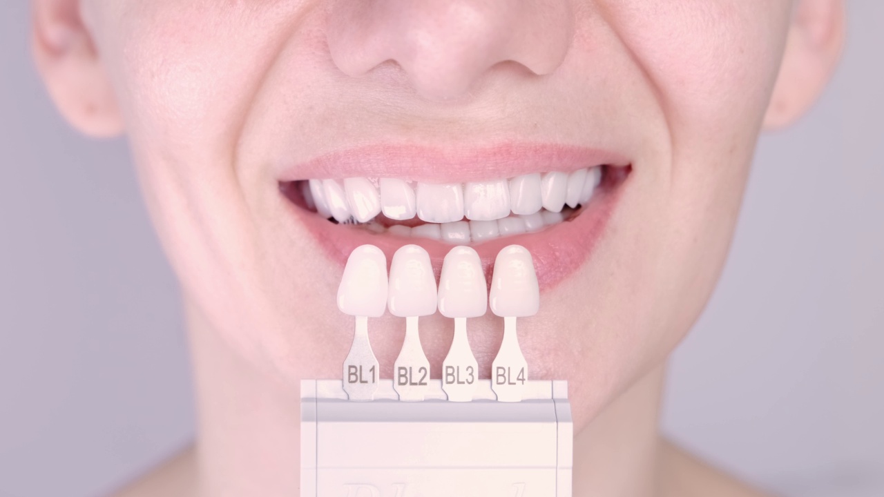 完美的白色牙齿接近与阴影指导漂白剂颜色，女性贴面微笑，牙科保健和口腔科，牙科。视频下载