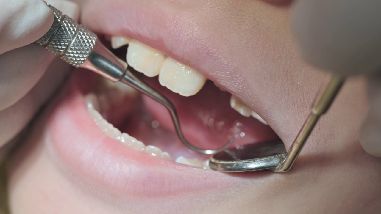近距离的亚洲华人牙医在牙医办公室用斜角镜检查小男孩的牙齿视频素材