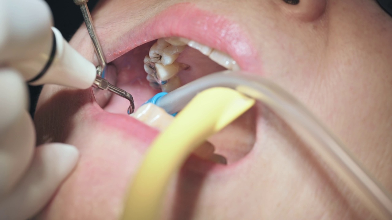牙科医生用吸管将病人牙菌斑口张开，闭合视频素材