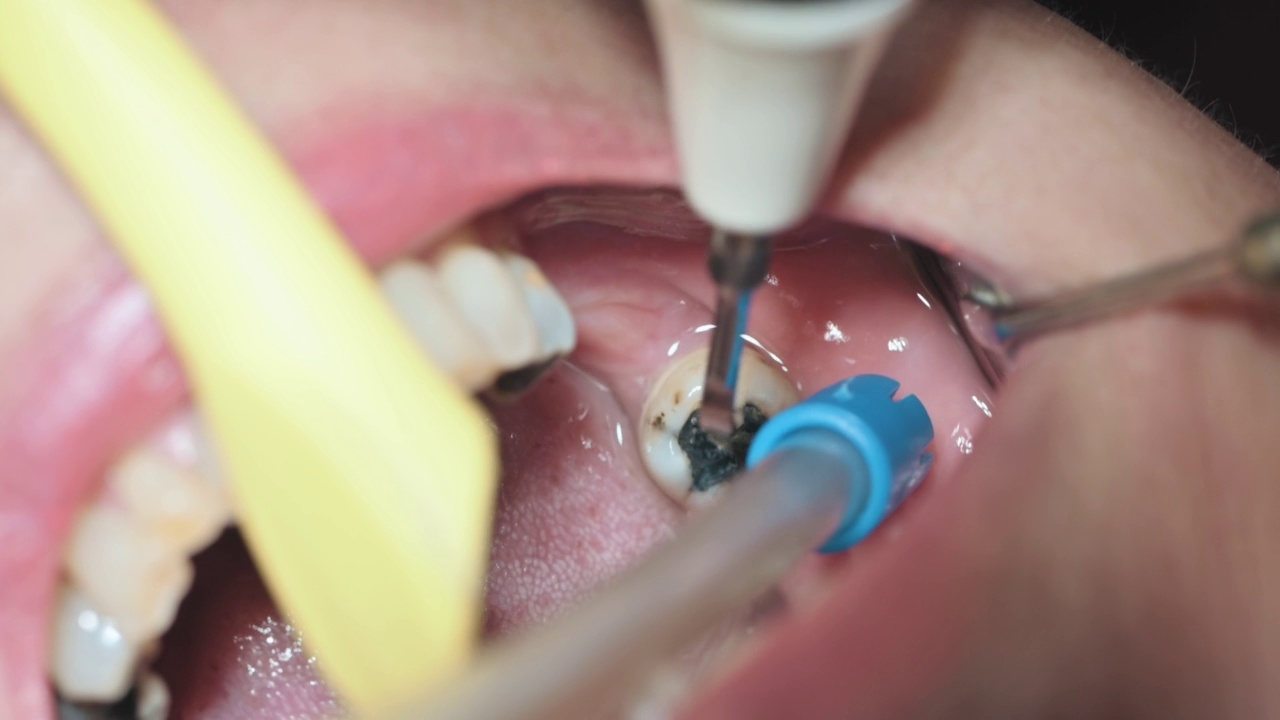 牙科医生用吸管将病人牙菌斑口张开，闭合视频素材