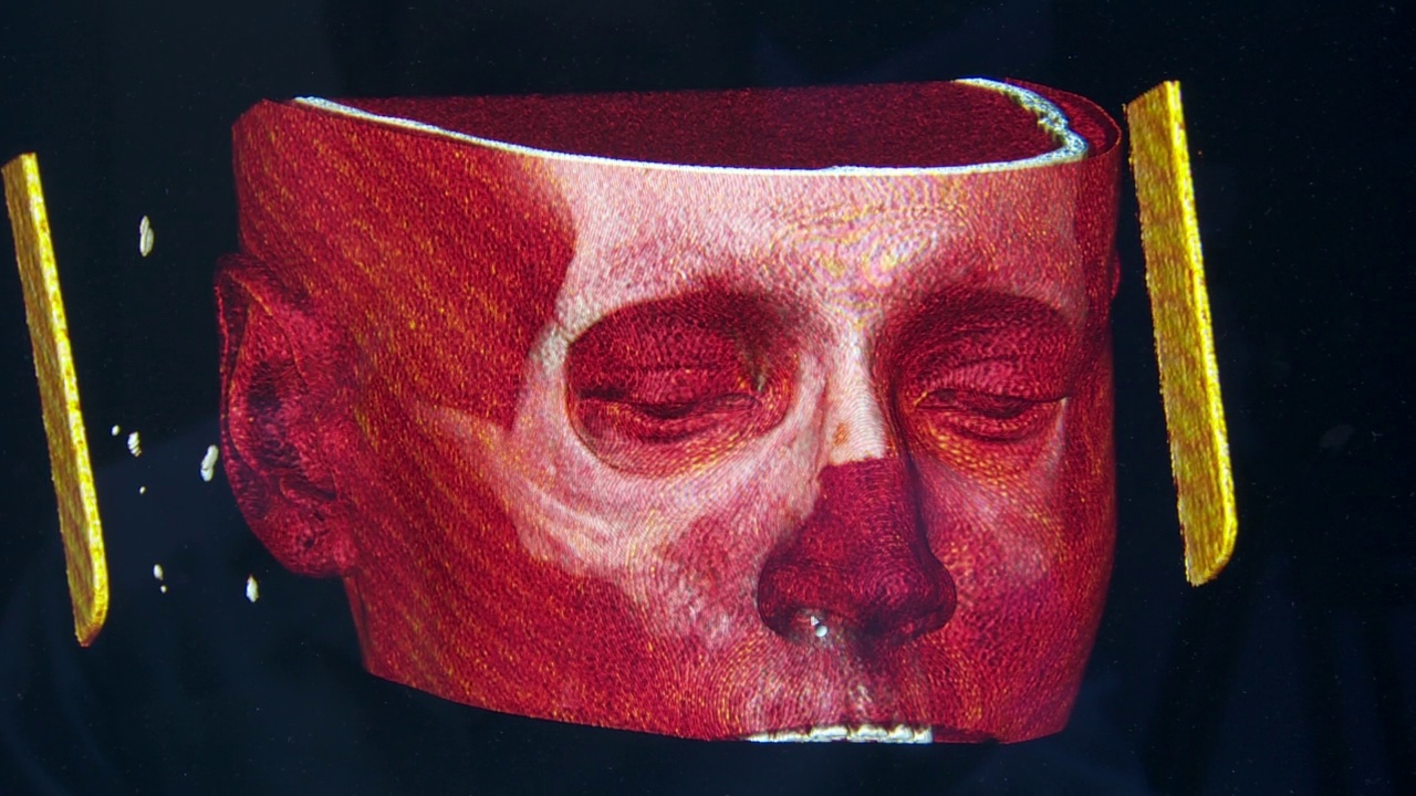 人类头部的断层扫描。屏幕上的头骨，通过计算机断层扫描研究大脑视频下载