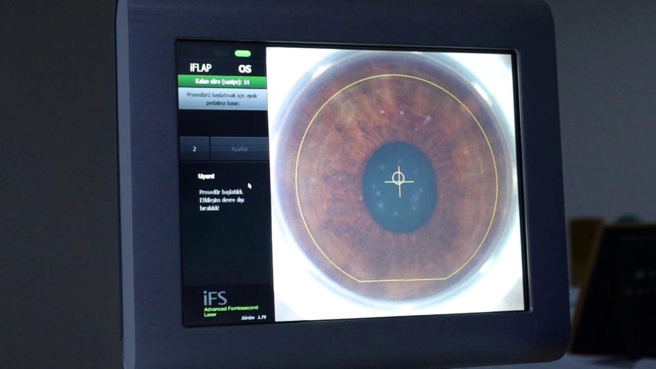 激光眼科手术中的激光操作，近景从监视器库存视频。在监视器上进行眼部激光扫描的全过程。视频下载