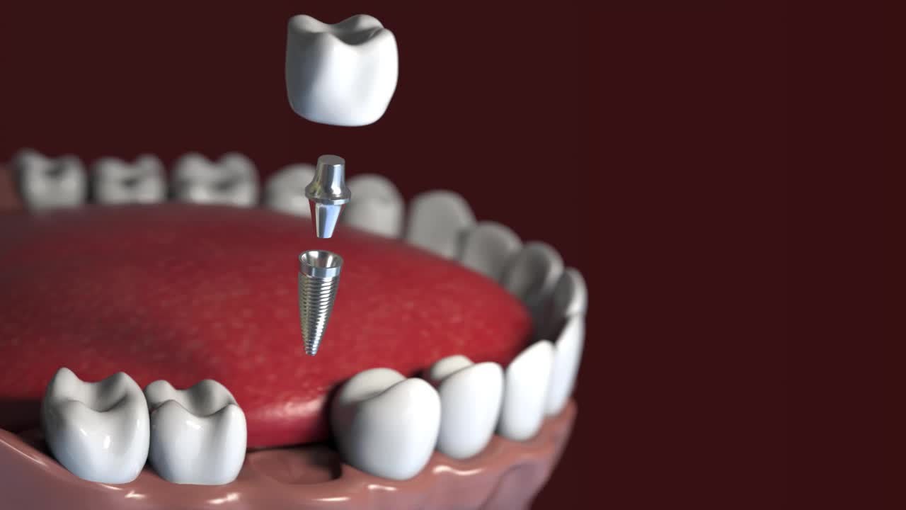 牙科植体安装。重建牙。根管治疗。视频素材