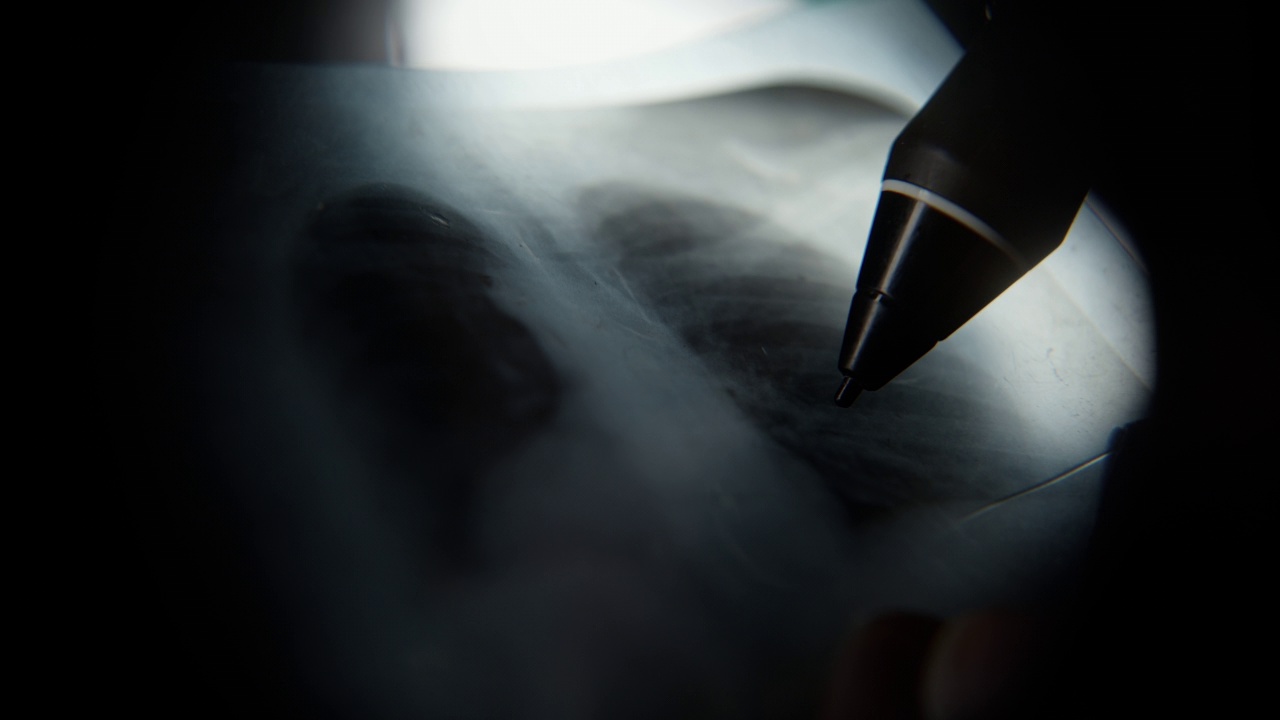肺x线极端特写，医生或教授用笔在x线上做检查，医学概念视频素材