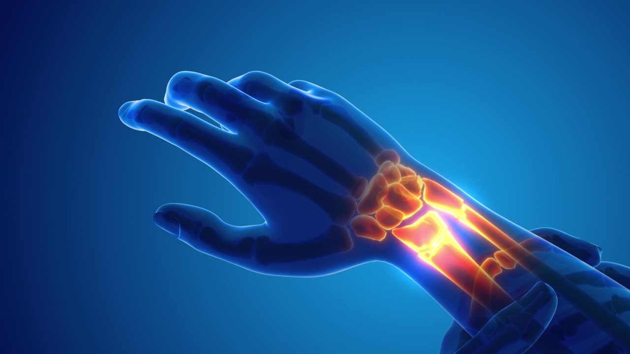 骨折腕骨痛的医学概念视频素材