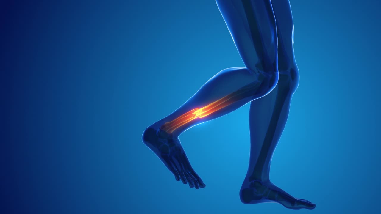 断腿骨痛的医学概念视频素材