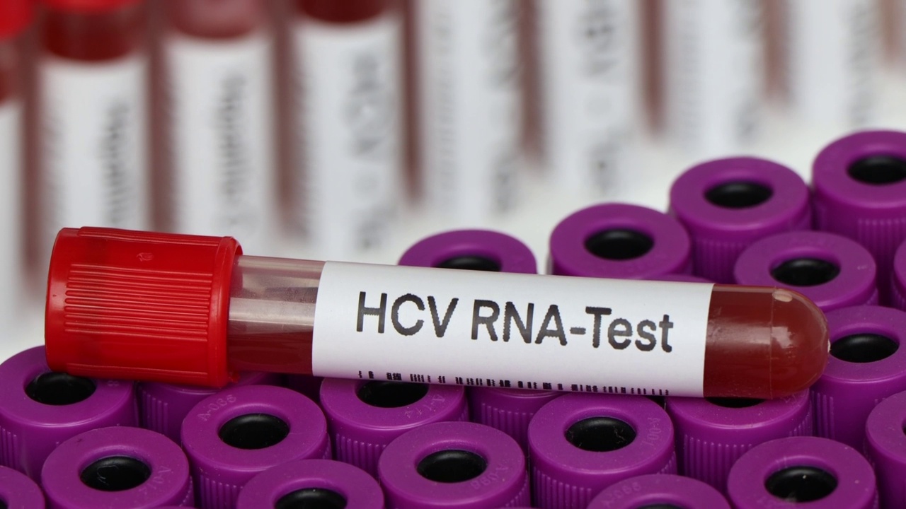 HCV RNA检测，从血液中寻找异常视频下载