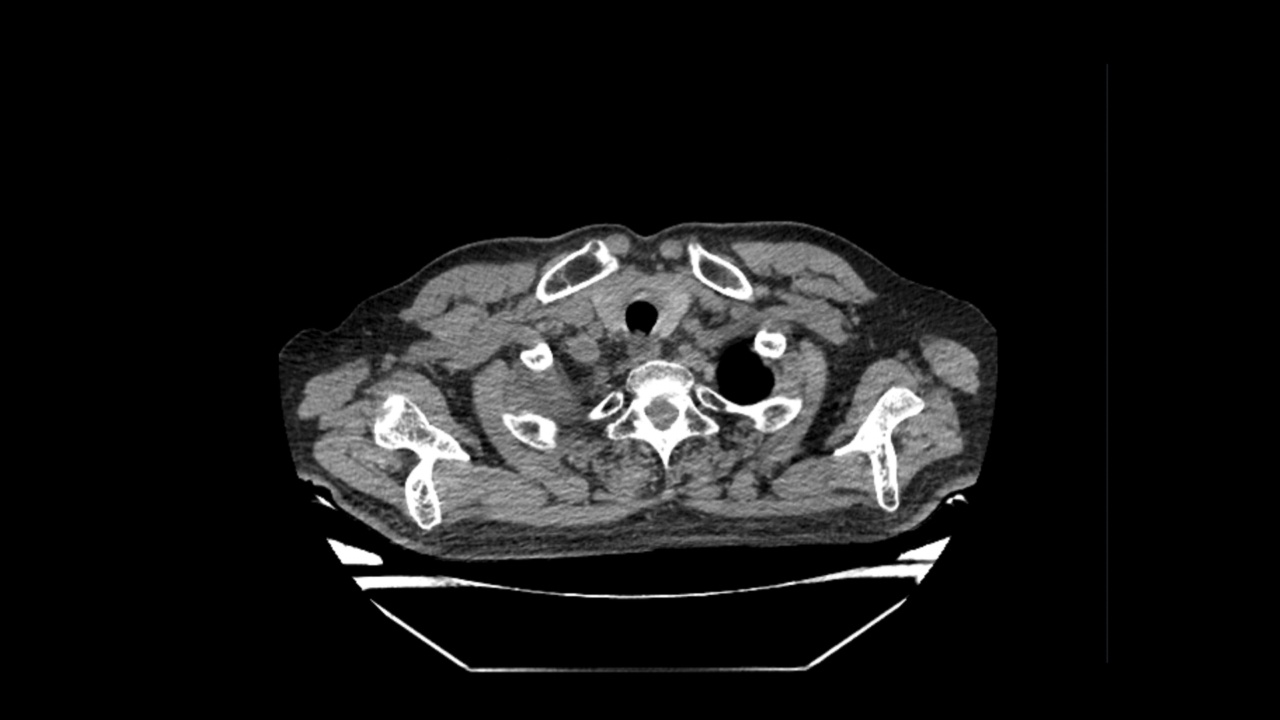 肺部肿瘤CT扫描视频素材
