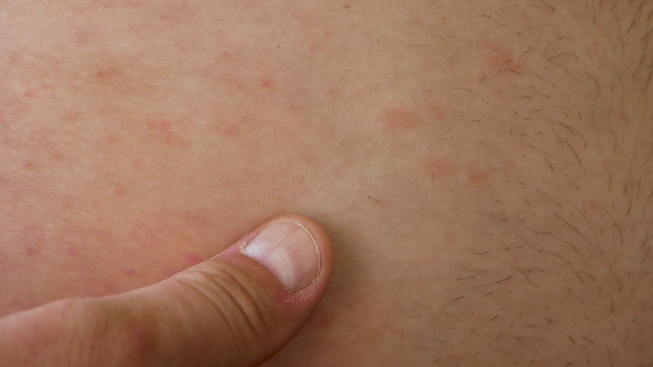 皮肤过敏的部位。皮肤上的过敏性皮疹特写。人类过敏疾病。男人皮肤上的红斑。中国的腹部皮肤病视频下载