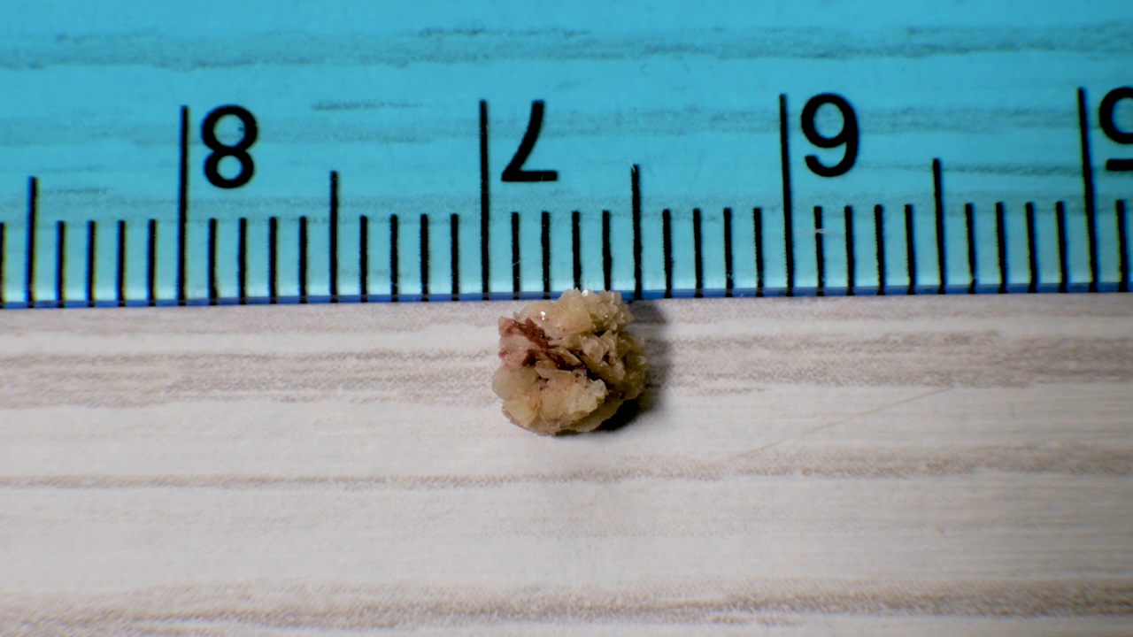 人体肾结石特写。草酸石从人肾中提取5毫米。视频下载