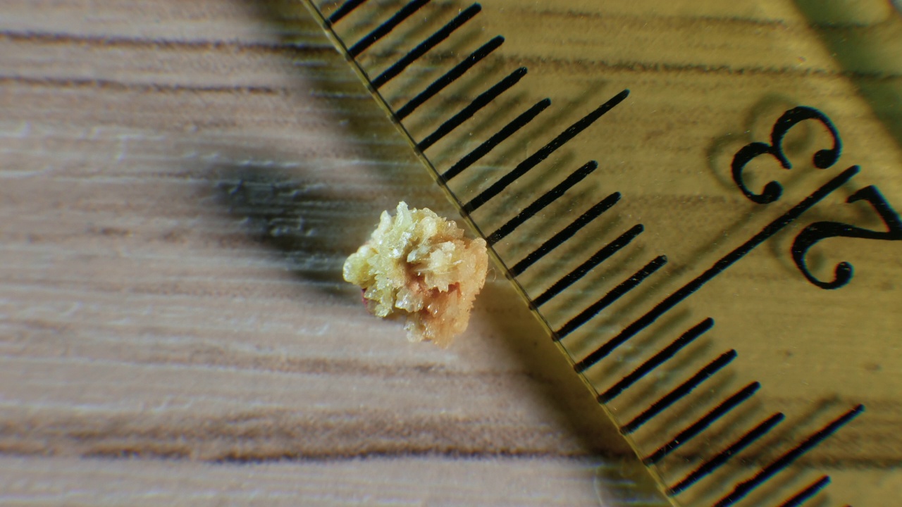 草酸肾结石4毫米，将结石从肾脏中取出，肾结石特写。视频下载