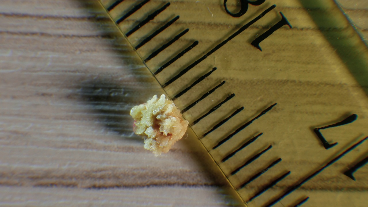 草酸肾结石4毫米，将结石从肾脏中取出，肾结石特写。手术后的人石演示视频下载