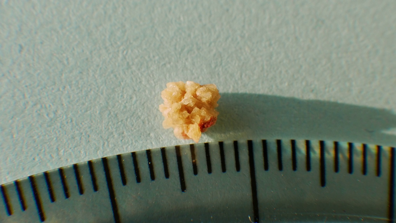 微距拍摄人体肾脏的草酸石特写，用尺子测量石头的大小。磷酸盐或尿酸盐结石从人类肾脏4毫米视频下载