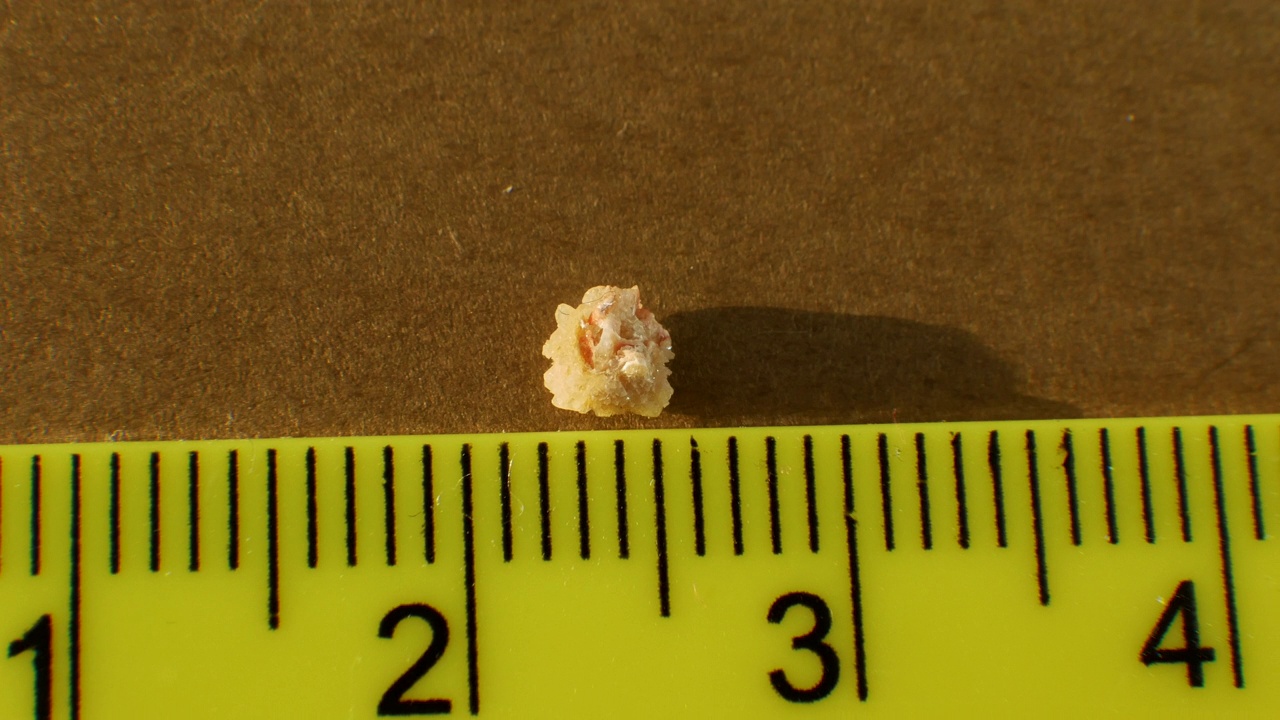 俯视图草酸石从人体肾脏的特写，用尺子测量石头的大小。人肾中磷酸盐或尿酸结石4毫米。肾结石检查视频下载