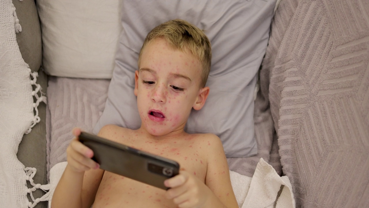男孩，躺在床上玩手机游戏，而他的皮肤上布满了痘视频下载