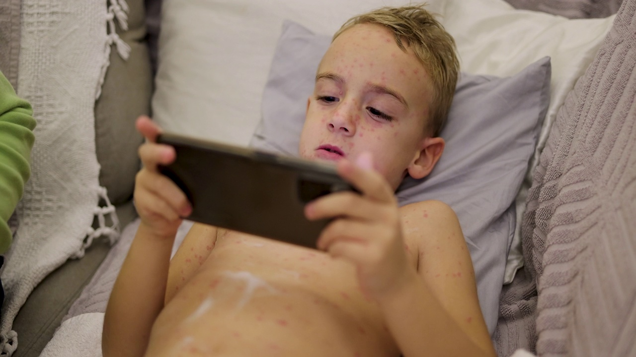 儿子玩手机游戏的时候，妈妈在他的皮肤上涂了一种乳液，以减少水痘的瘙痒视频下载