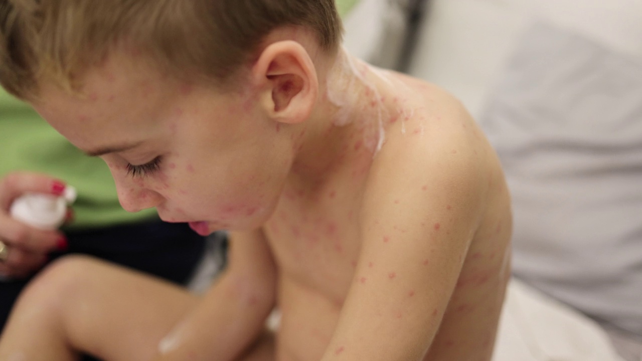 B-roll的母亲在她儿子的皮肤上涂了一种乳液，以减少水痘的瘙痒视频下载