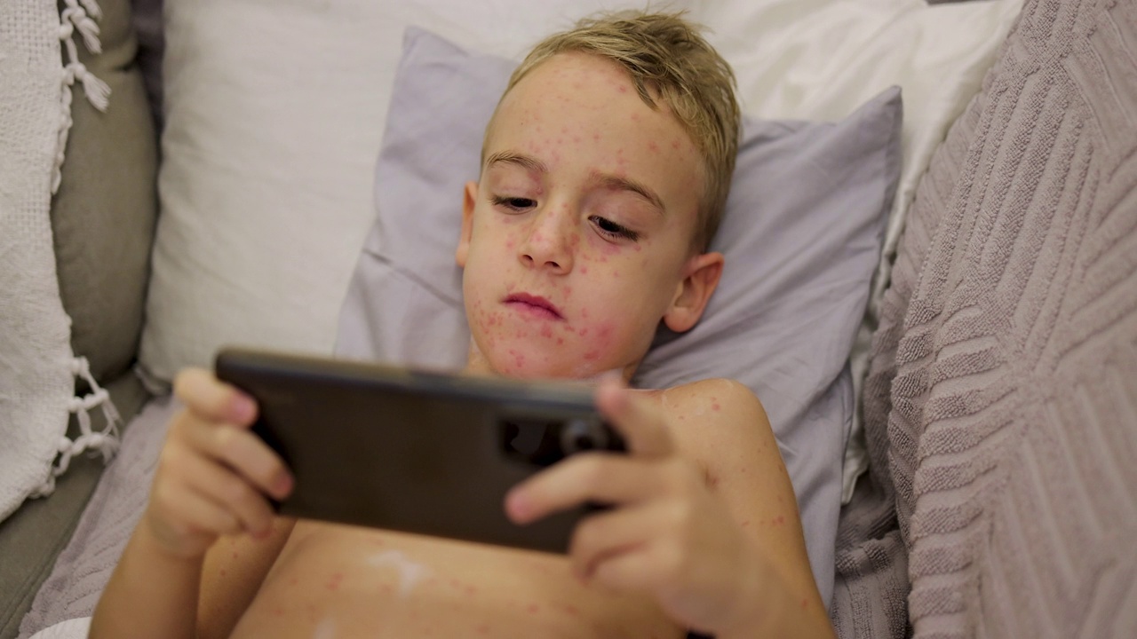 儿子玩手机游戏时，母亲在他的皮肤上涂了一种药膏，以减轻水痘的瘙痒视频下载