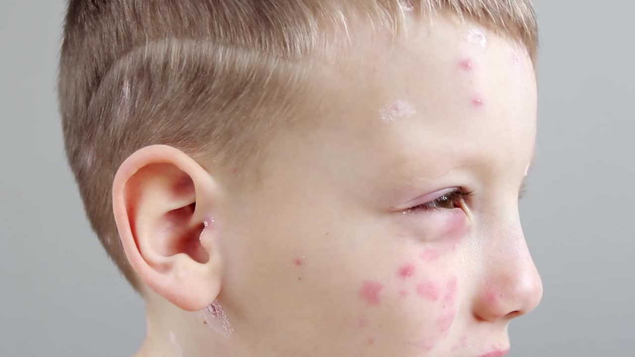 水痘病特写-一个小男孩的肖像。过敏性皮疹儿童脸上的皮肤状况视频下载