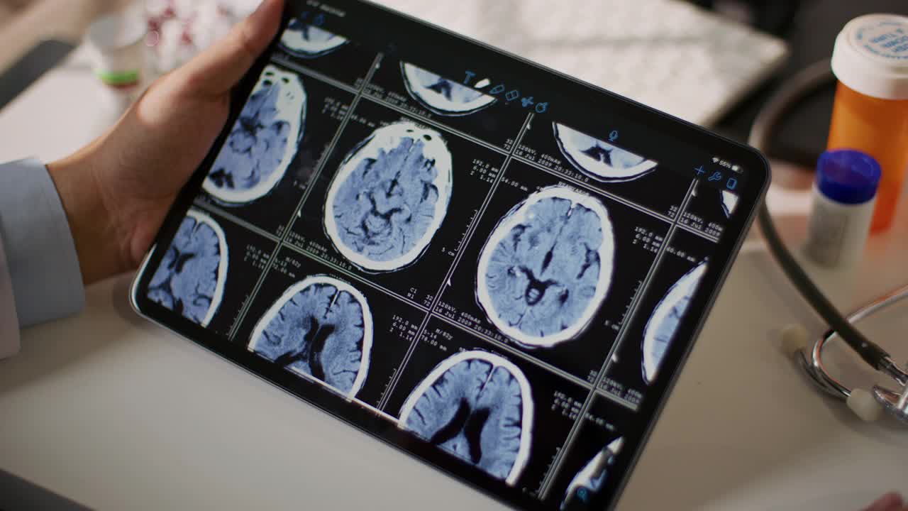 女医生们正在看平板电脑上的脑部扫描图视频素材