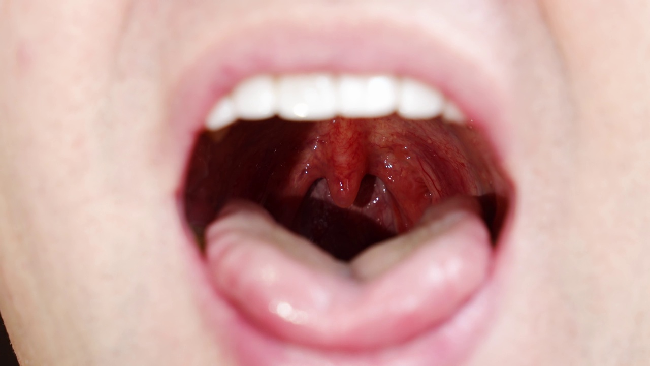 一个男人的嘴巴特写。咽喉的腭小舌和粘膜。视频下载