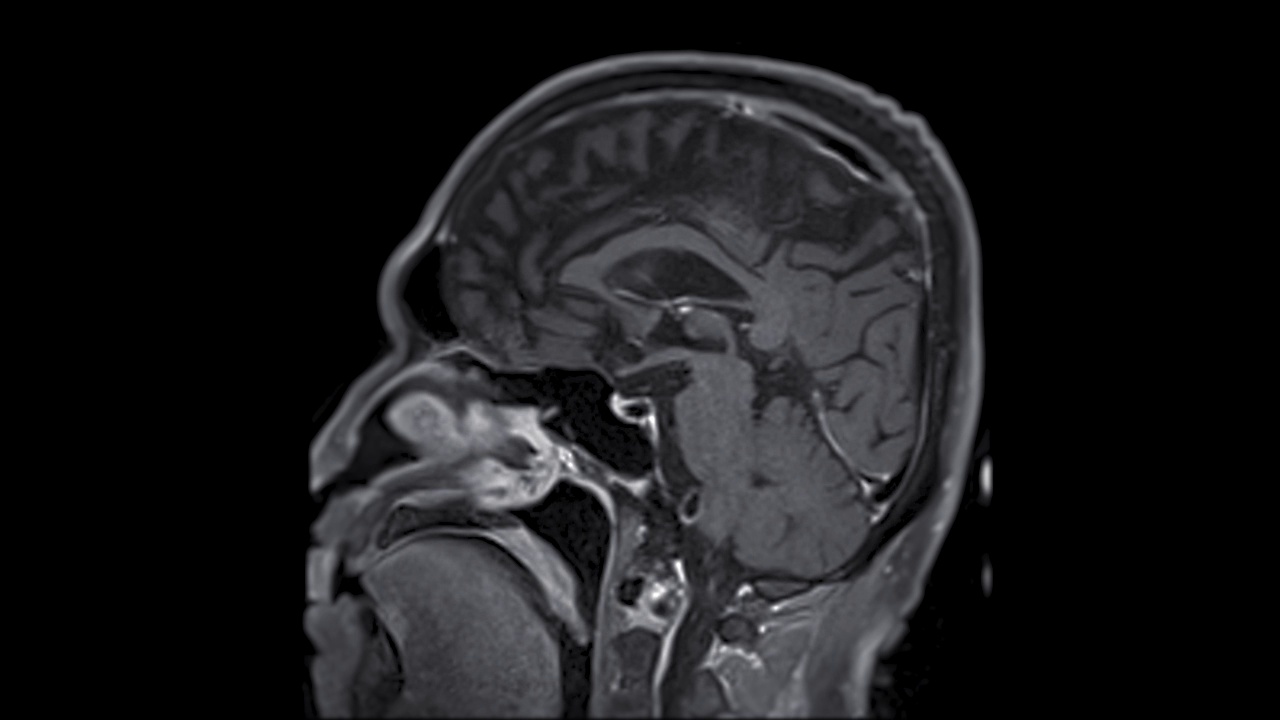 MRI脑矢状面。视频下载