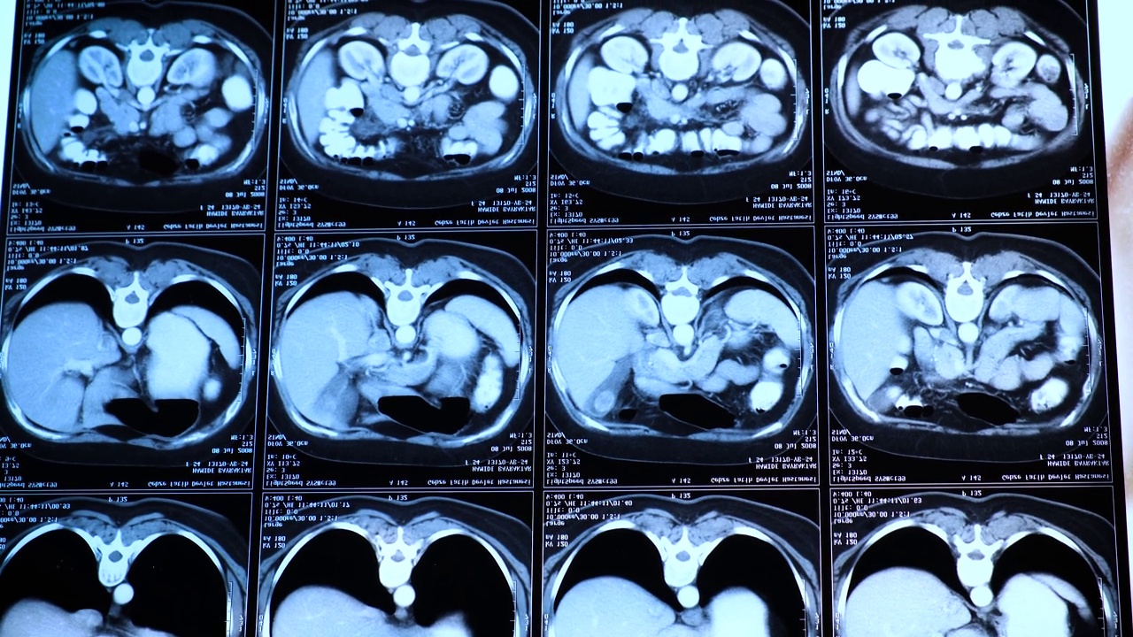 胸部腹部计算机断层扫描(CT)。医学、科学和教育CT背景视频下载