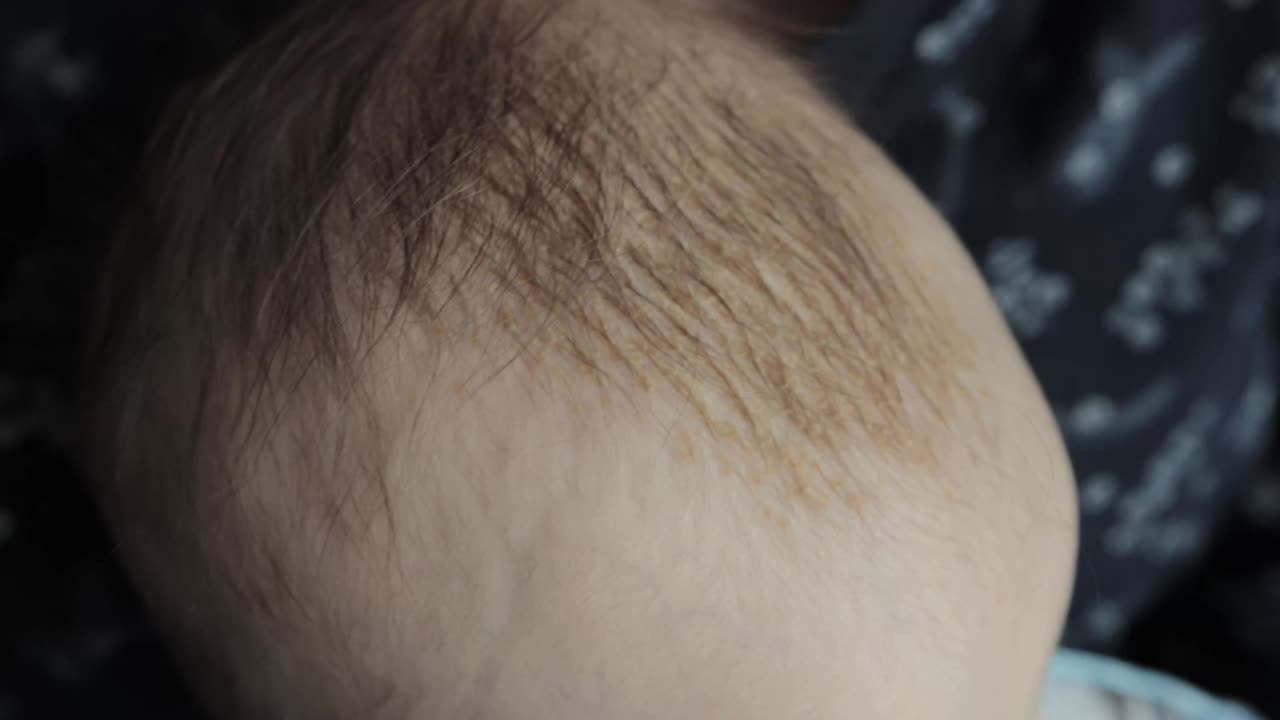 6个月大婴儿头部皮肤脂溢性皮炎。头部黄色鳞片，特写视频下载