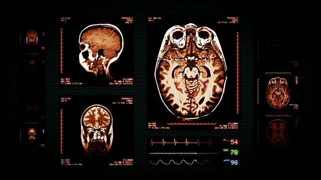 脑部核磁共振成像扫描。顶部，正面和侧面视图。琥珀。视频素材
