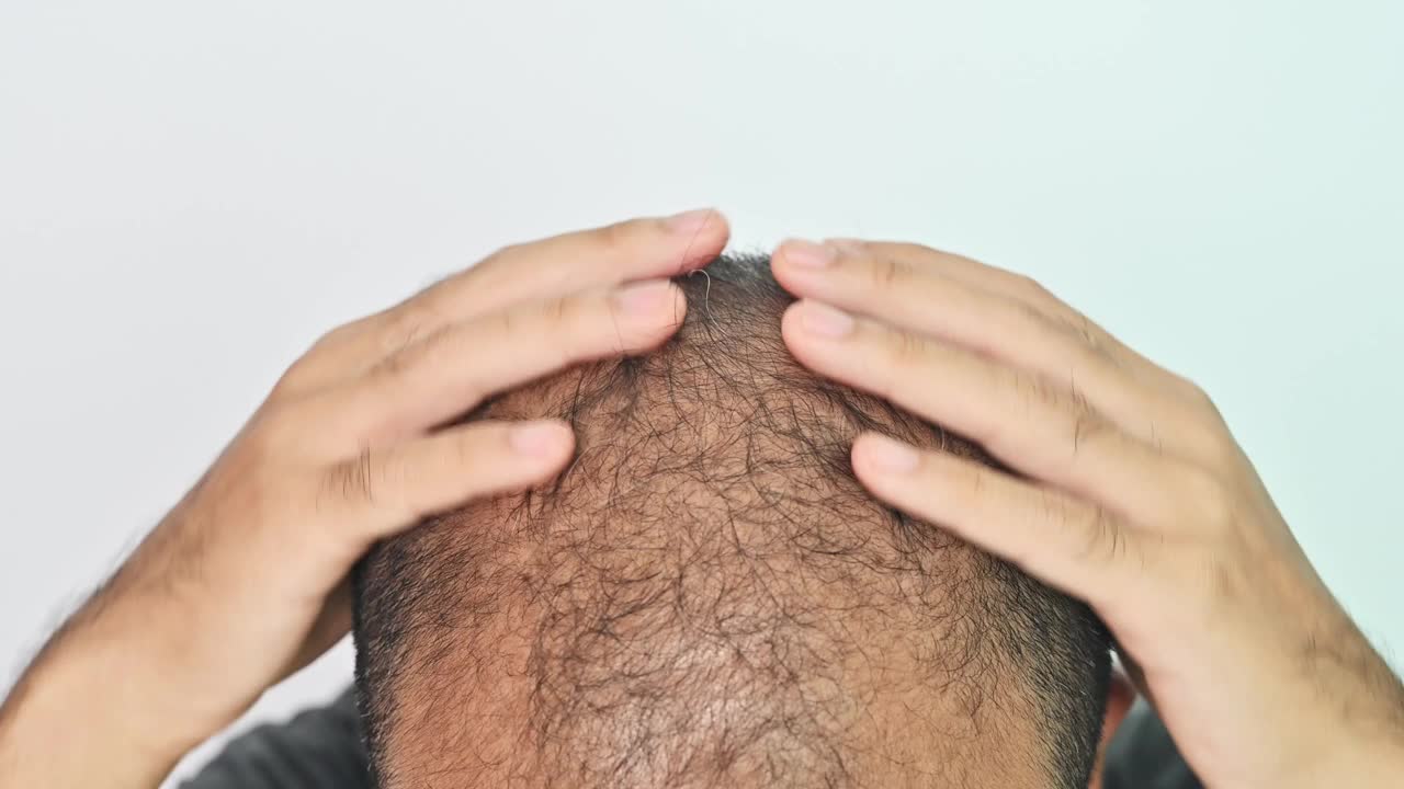 亚洲秃顶男子摸着自己的头，显示出脱发的问题。视频下载