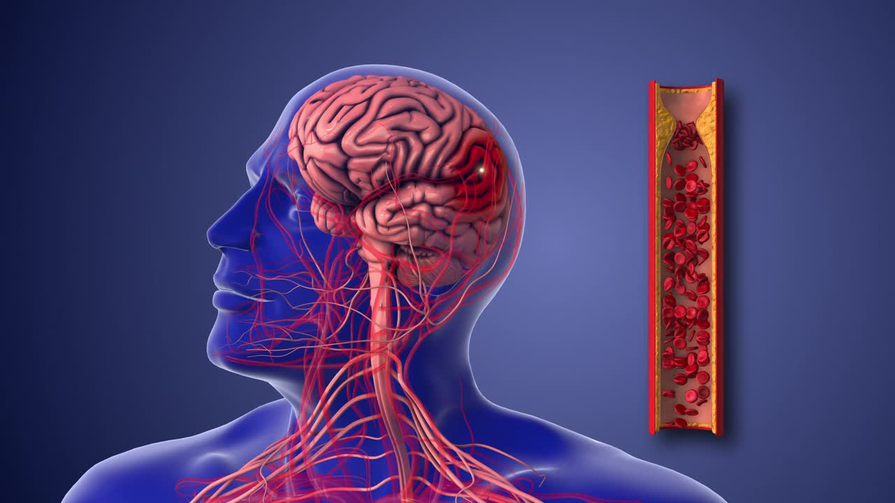 缺血性中风或由动脉粥样硬化性狭窄引起的脑血管疾病视频下载