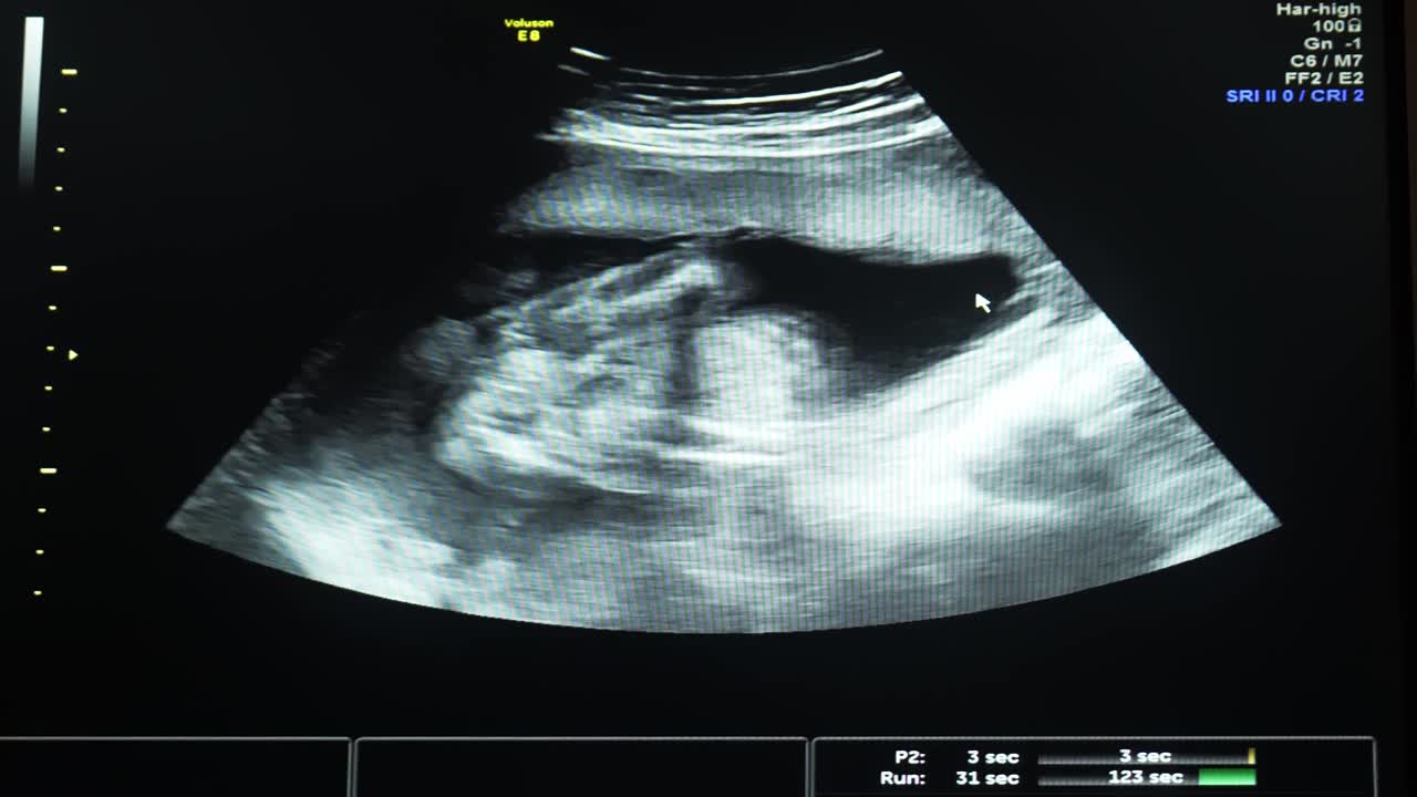 胎儿在子宫内的超声波特写视频素材