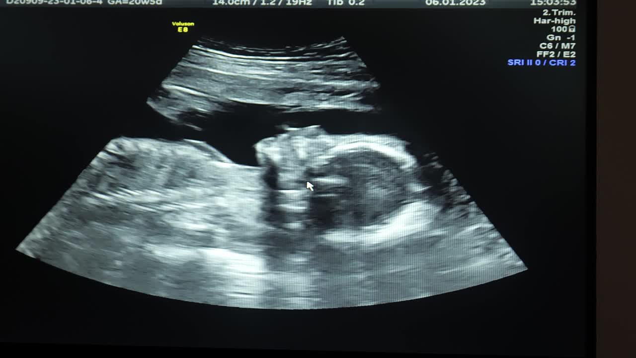 胎儿在子宫内的超声波特写视频下载