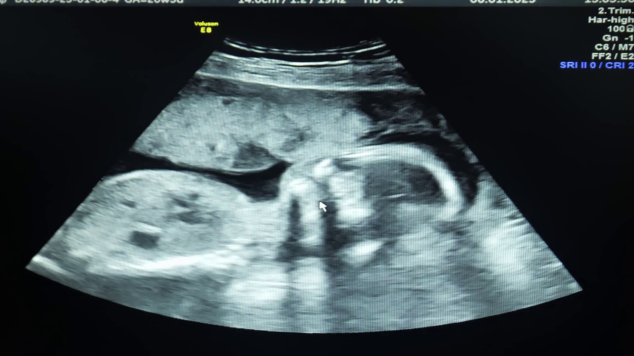 胎儿在子宫内的超声波特写视频下载