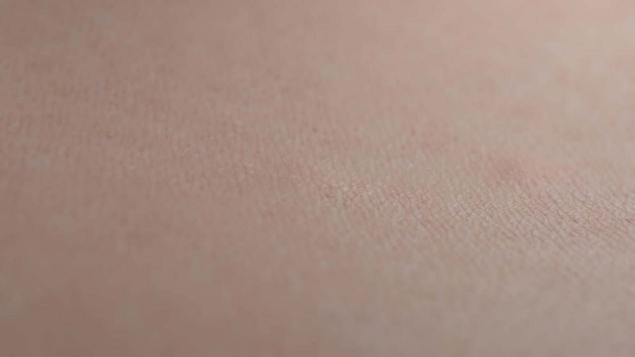 由于毛孔堵塞，粉刺会从皮肤上冒出来视频下载