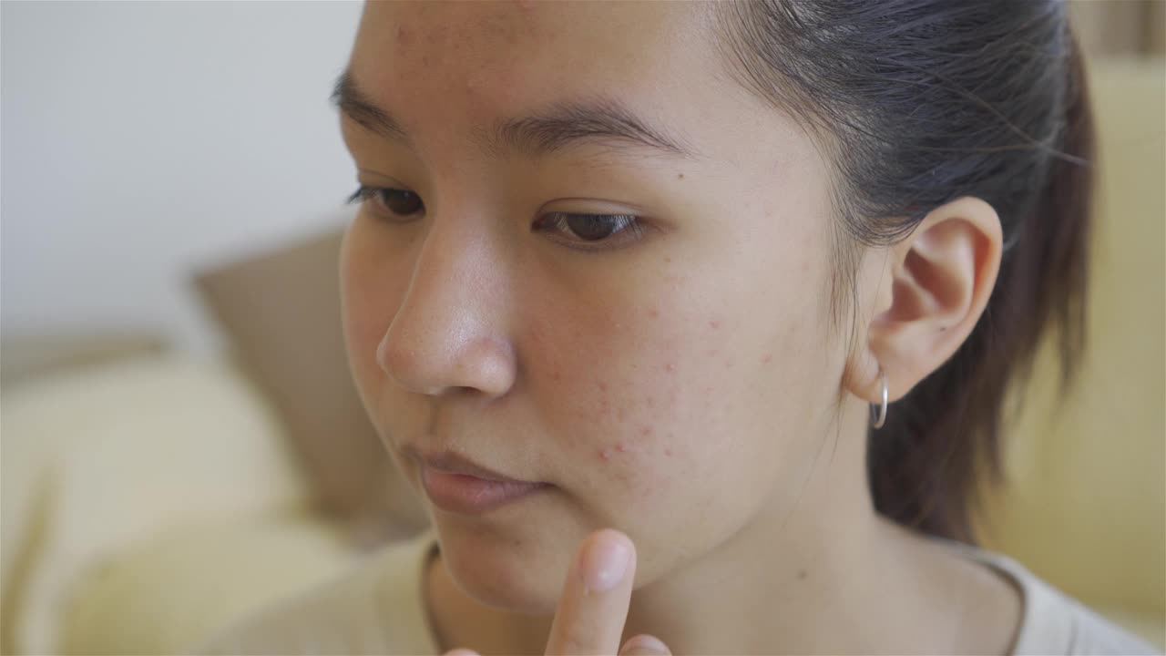 一位长粉刺的女士正在使用护肤品。视频下载