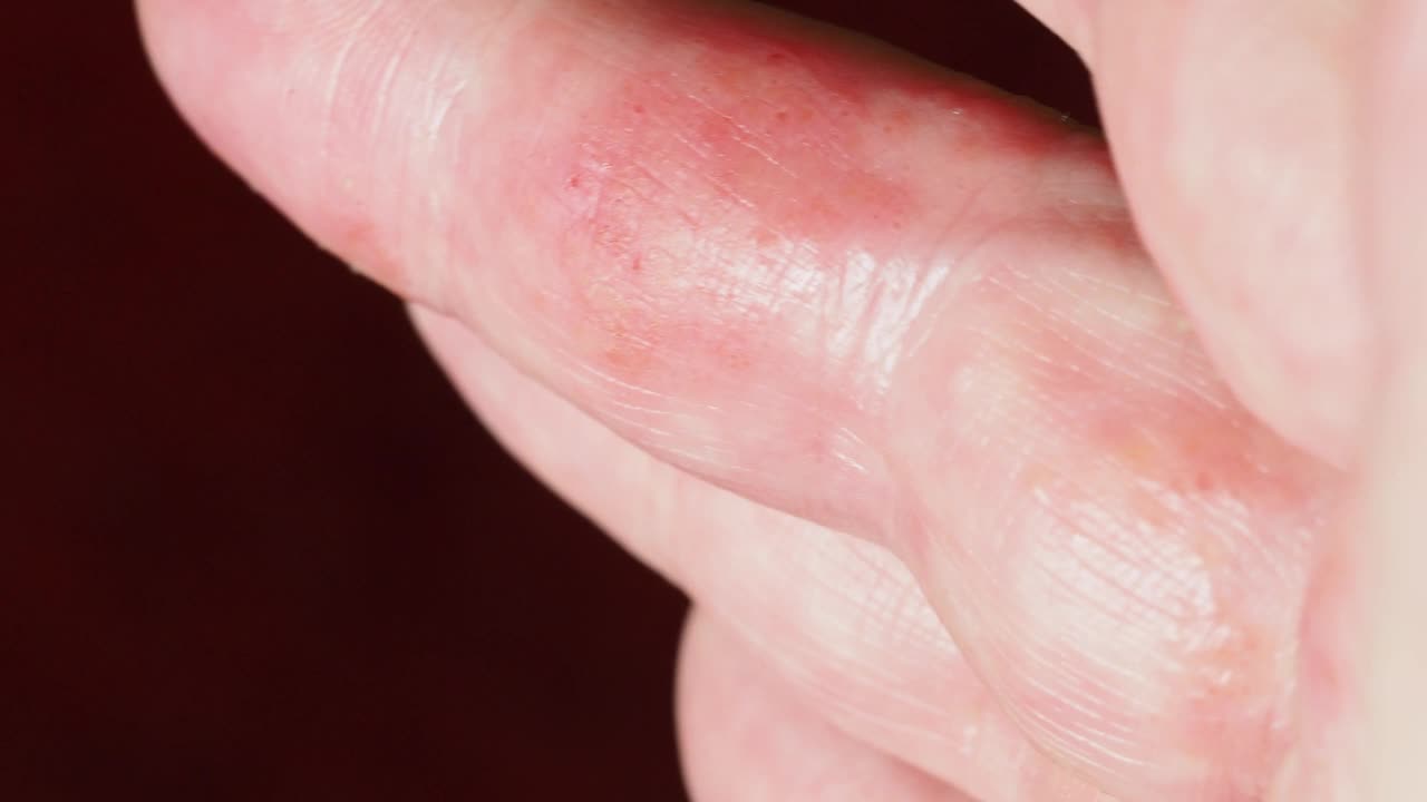 手和手指的特应性皮炎湿疹视频下载