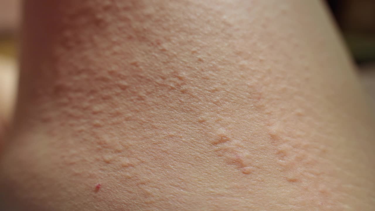 湿疹发生在夜间亚洲中年妇女的腿在森林旅行时，它发生在抓挠视频下载