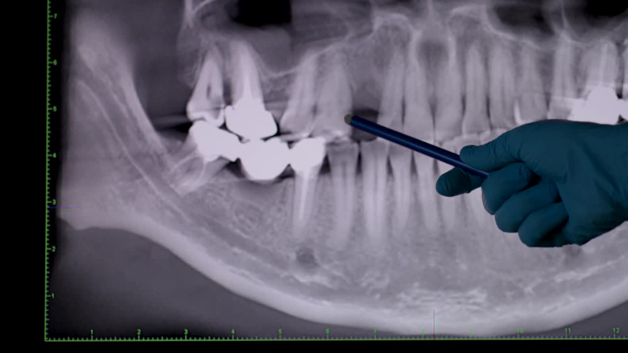 牙医分析牙科x光片。医生正在检查牙科x光片视频下载