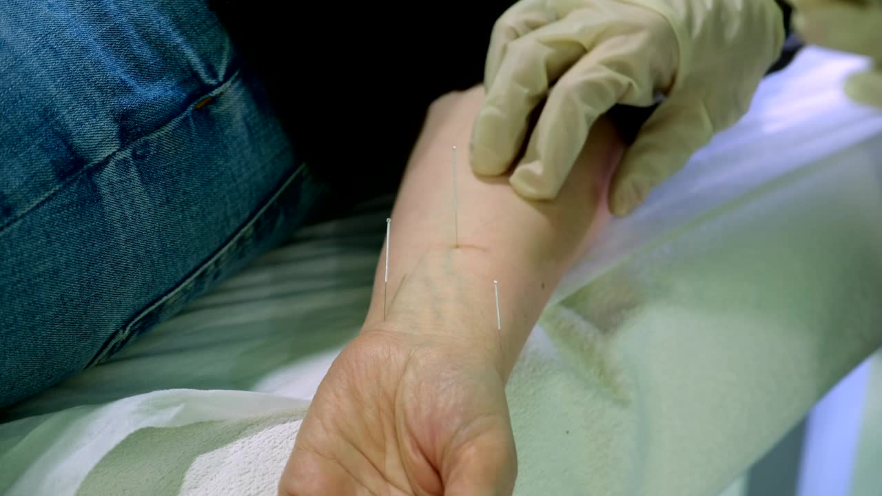 正在接受手部针灸治疗的妇女。替代医学。视频下载