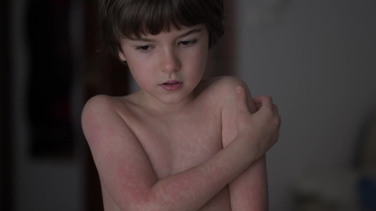 孩子抓伤身上的红疹。男孩抓伤特应性皮肤。儿童身体及面部的皮炎、皮肤不适、荨麻疹及过敏。刺激和瘙痒。男孩皮肤对食物过敏。视频下载