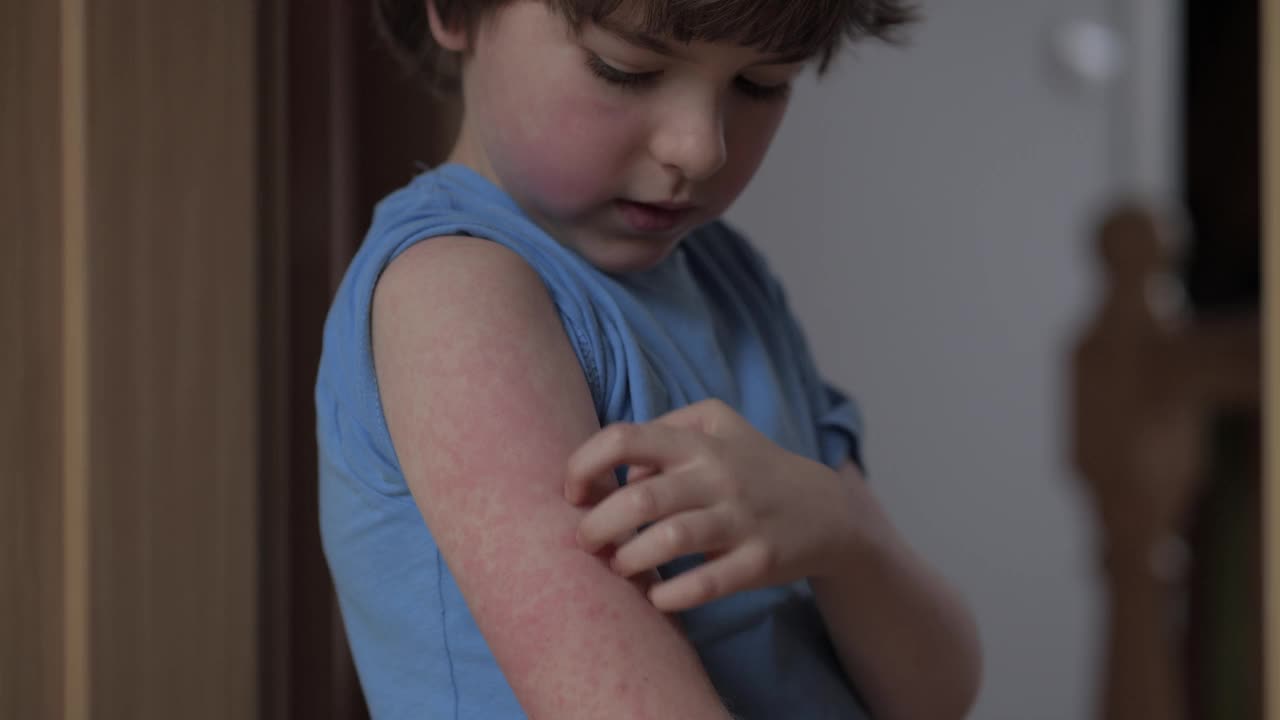孩子在手上抓红疹。男孩抓伤特应性皮肤。儿童身体及面部的皮炎、皮肤不适、荨麻疹及过敏。刺激和瘙痒。男孩皮肤对食物过敏。视频下载