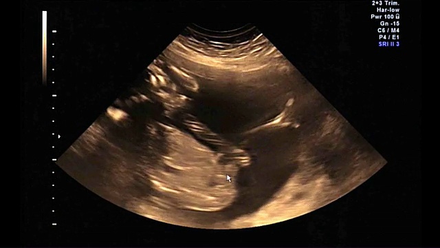 婴儿或胎儿在21周时踢的超声波视频素材