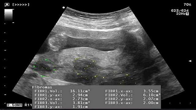 子宫肌瘤超声测量视频下载