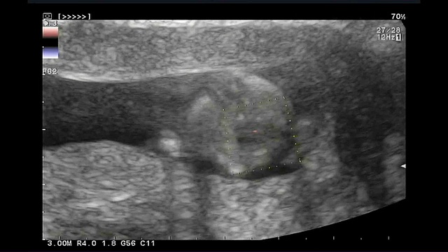 一个十三周有心跳的婴儿的超声波视频素材