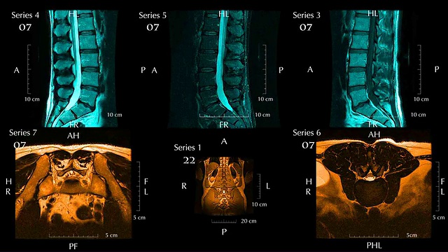 MRI腰椎或脊柱下段视频下载