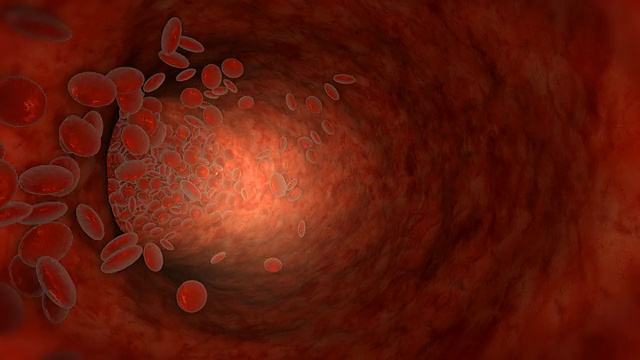 人体血管内的血细胞，流动受阻视频素材