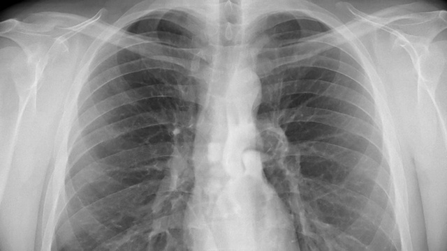 胸部x光片。视频下载