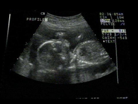吸婴拇指超声波视频素材